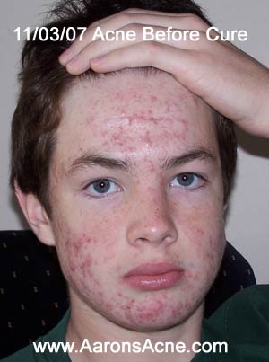 accutane before and after. face looked like efore I
