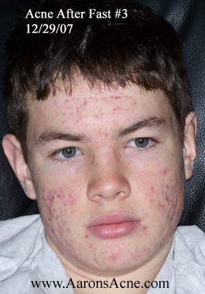  and a lot of the redness is gone. Acne after fast #3 , aaron's acne cure
