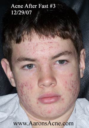 After Acne